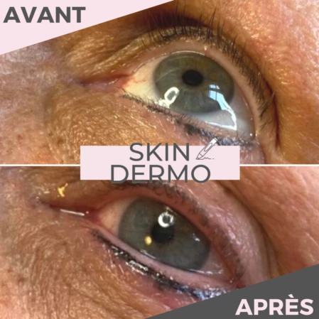 Photo avant/après d'une correction de raté d'un maquillage permanent des yeux
