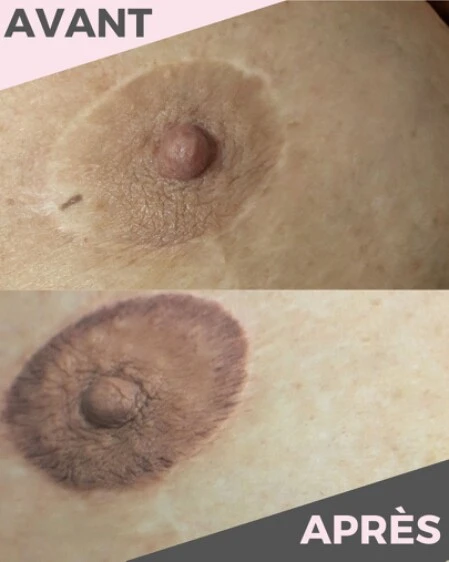 Photo avant/après d'une dermopigmentation d'aréole mammaire en 3D.