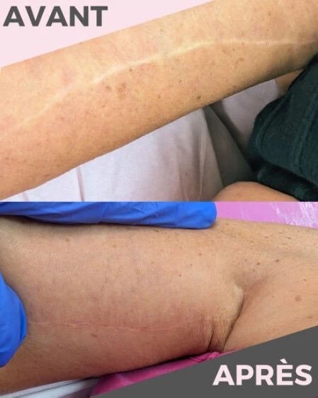 Photo avant/après d'une dermopigmentation pour camoufler une cicatrice
