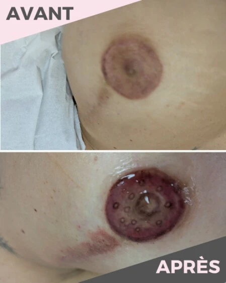 Photo avant/après d'une dermopigmentation d'aréole mammaire en 3D.