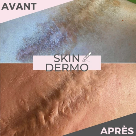 dermopigmentation-camouflage-cicatrice-skin-dermo Photo avant/après d'une dermopigmentation pour camoufler une cicatrice