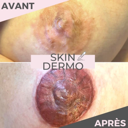 dermopigmentation-symetrisation-areole-mammaire Photo avant/après d'une dermopigmentation pour une symétrisation des aréoles mammaires après une réduction mammaire