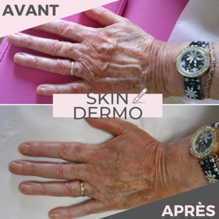 dermopigmentation-camouflage-vitiligo-skin-dermo Photo avant/après d'une dermopigmentation pour camoufler un vitiligo