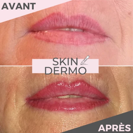 Photo avant/après d'une correction d'un ancienmaquillage permanent des lèvres raté