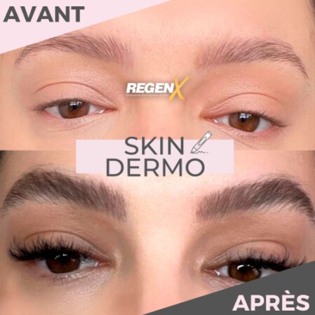Reconstruction de poil de sourcil