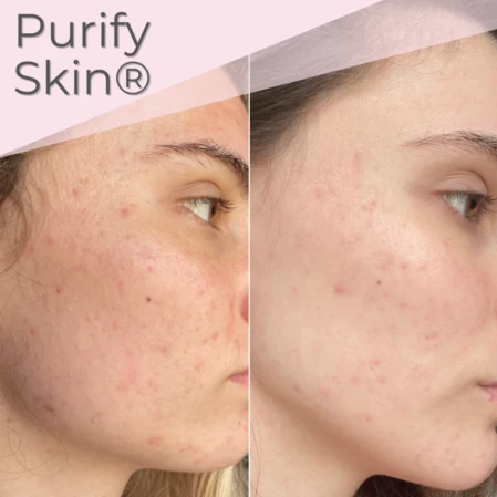 Soin Purify Skin pour les peaux acnéiques au Puy en Velay Avant/Après du soin Purify Skin